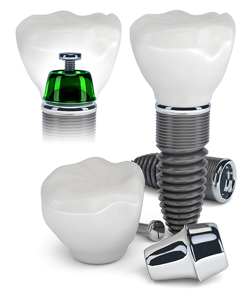 Implant Dentist in Uptown Chicago