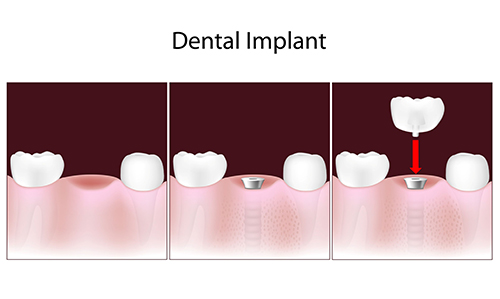 Dental Implants in West Edgewater