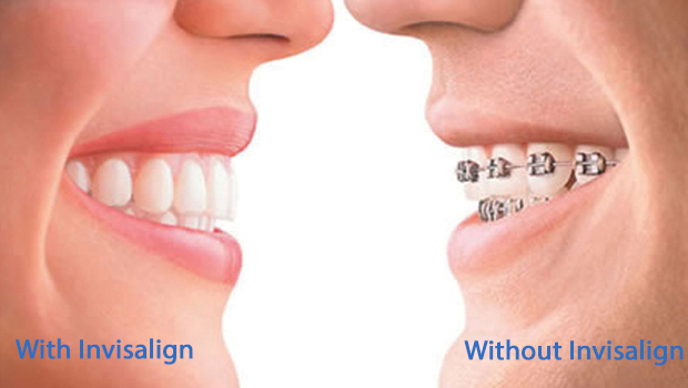 Invisalign in Andersonville