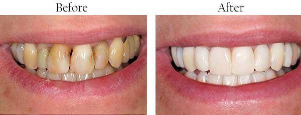 Andersonville Before and After Teeth Whitening