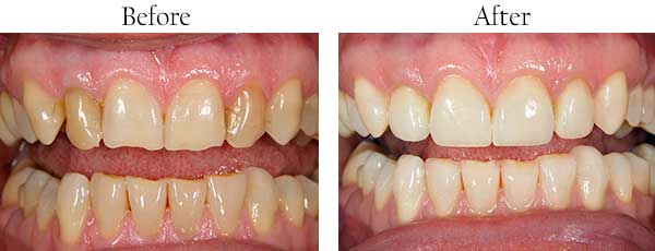 West Edgewater Before and After Invisalign