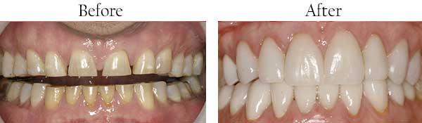 Andersonville Before and After Teeth Whitening