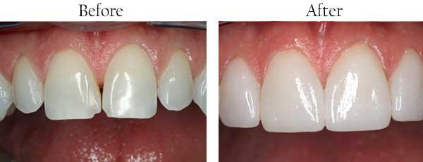 West Edgewater Before and After Invisalign